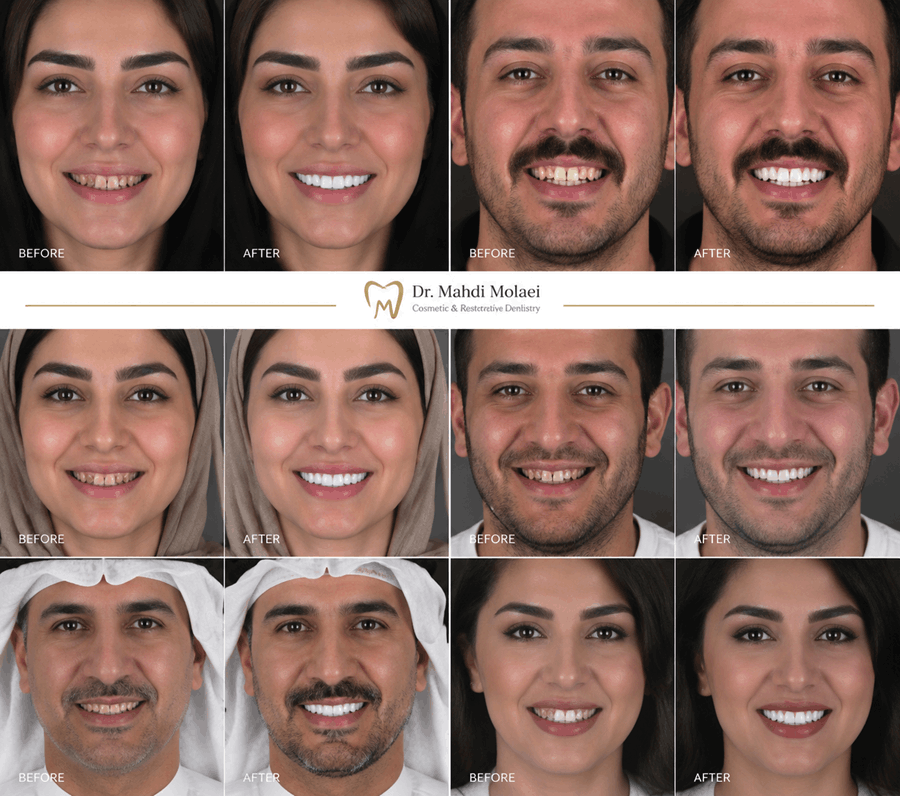 بلیچینگ لیزری